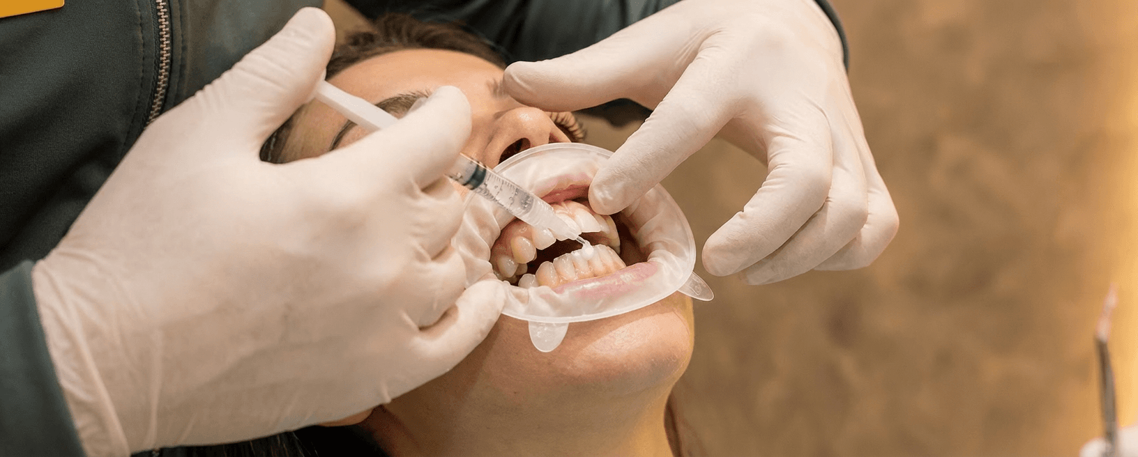 Quando clarear os dentes?